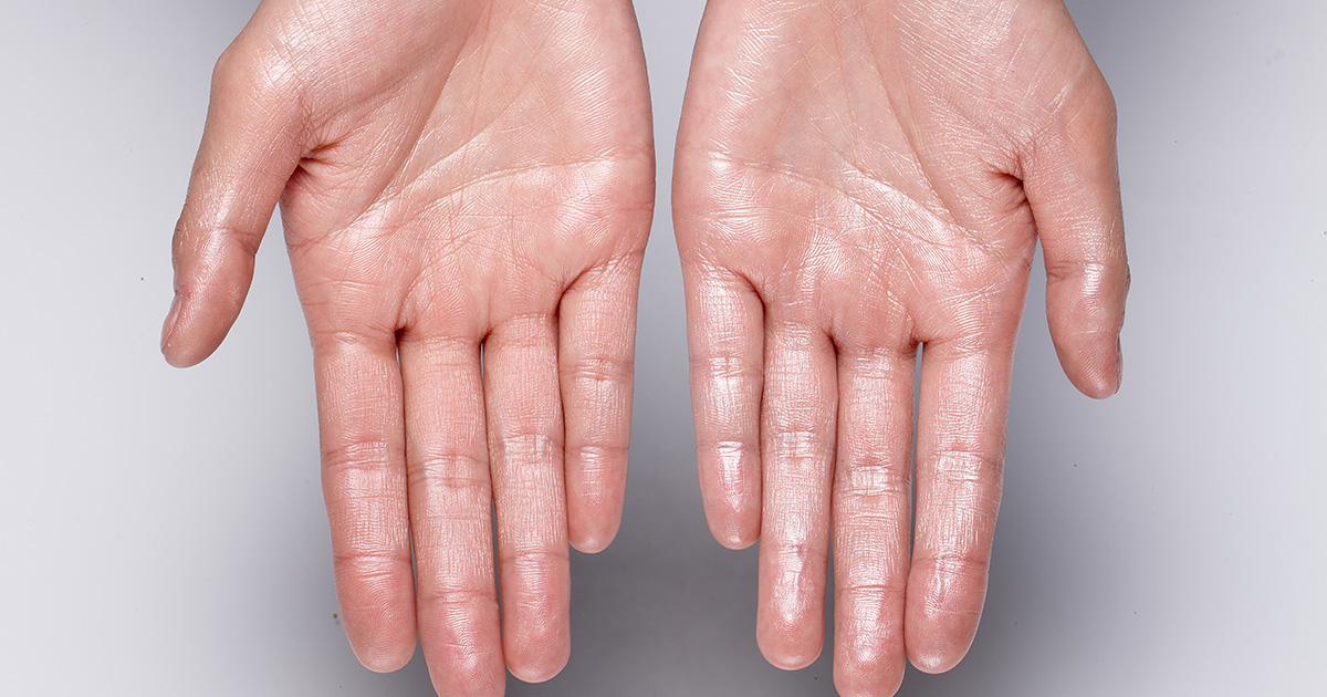 palmar-hyperhidrosis-1200-630