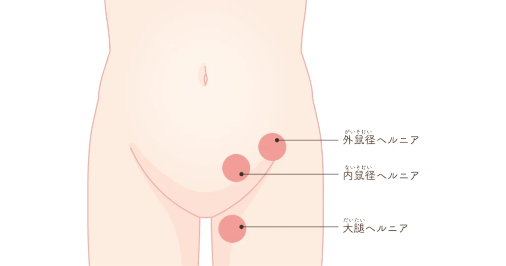 鼠径ヘルニア 分類
